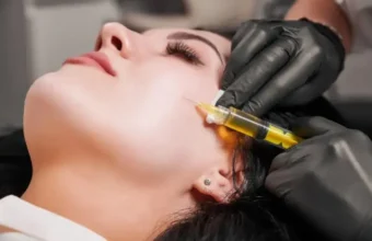 PRP therapy hair treatment